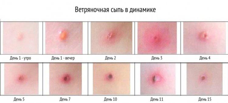 ЖЕЛШЕШЕК (ВЕТРЯНКА) АУЫРУЫ жайында айтамыз